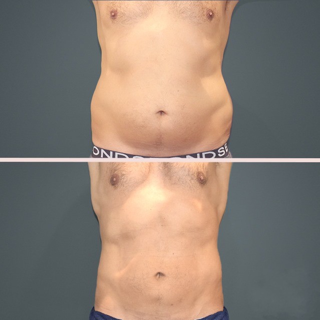 lipo trunk men 1α